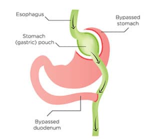 Gastric Bypass surgery (Roux-en-Y) Barrington, IL [Advanced Bariatrics]