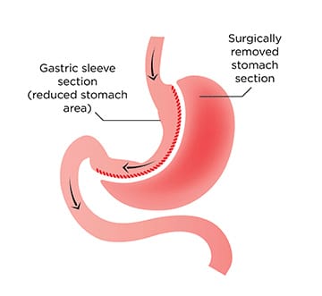 Gastric Sleeve surgery (Sleeve Gastrectomy) | Barrington, IL